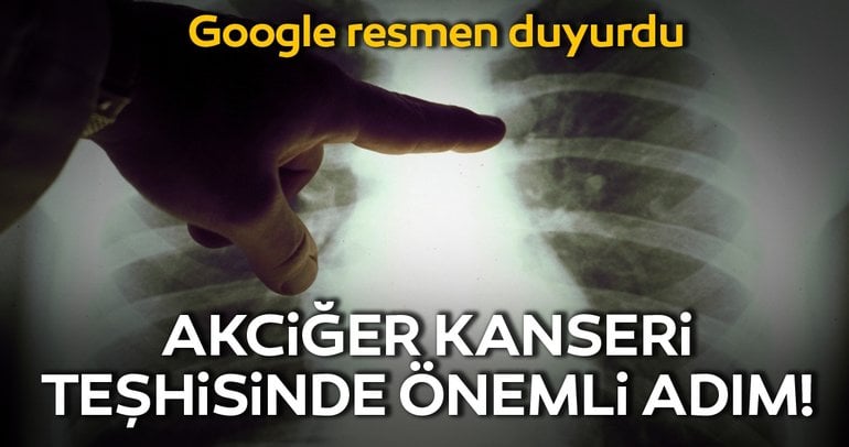 Google, Yapay Zeka İle Akciğer Kanserini Erken Teşhis Edebilecek