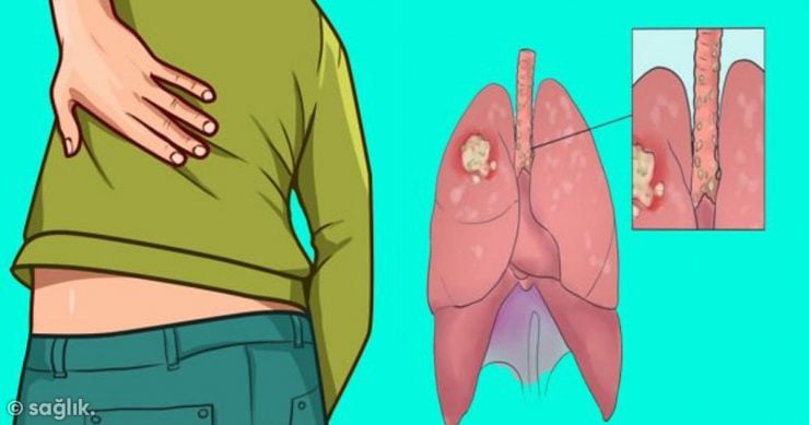 Akciğer Kanserinin Belirtilerini Öğrenin ve Önlemlerini Alın