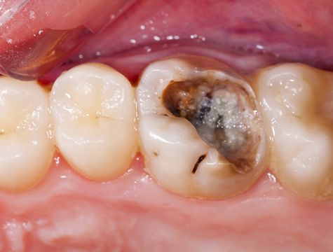 Diş Çürümesine Neden Olan Yiyecekler
