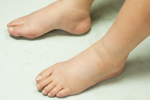 Bacaklardaki Şişlik Hastalık Habercisi Olabilir