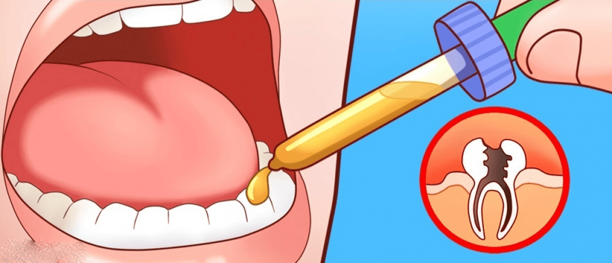 Diş Ağrınızı Evdeki Yöntemler İle Geçirebilirsiniz ?