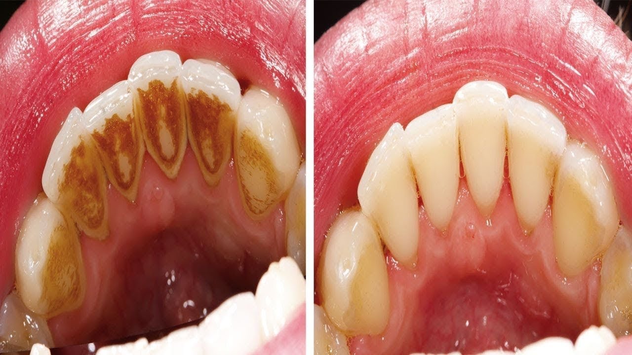 Bu Ev Yapımı 4 Tarif İle Dişlerinizi Tartar Diş eti İltihabını Ve