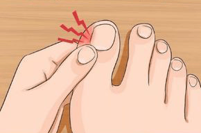 Ayağınızdaki Batık Tırnağını Doktora Gitmeden Tedavi Edebilirsiniz