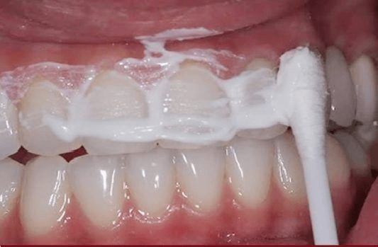 Dişlerinizi Bu 4 Adımla Sağlıklı ve Bembeyaz Yapabilirsiniz