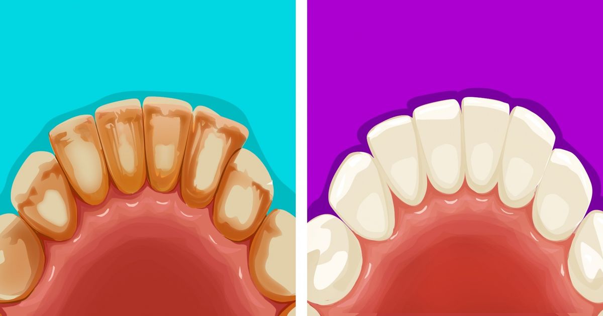 Dişlerinizdeki plakları çıkarmanın 6 yolu
